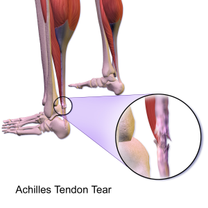 Sơ đồ giải phẫu gân Achilles và điểm tổn thương