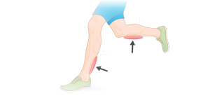 Minh hoạ vị trí đau shin splint ở cẳng chân